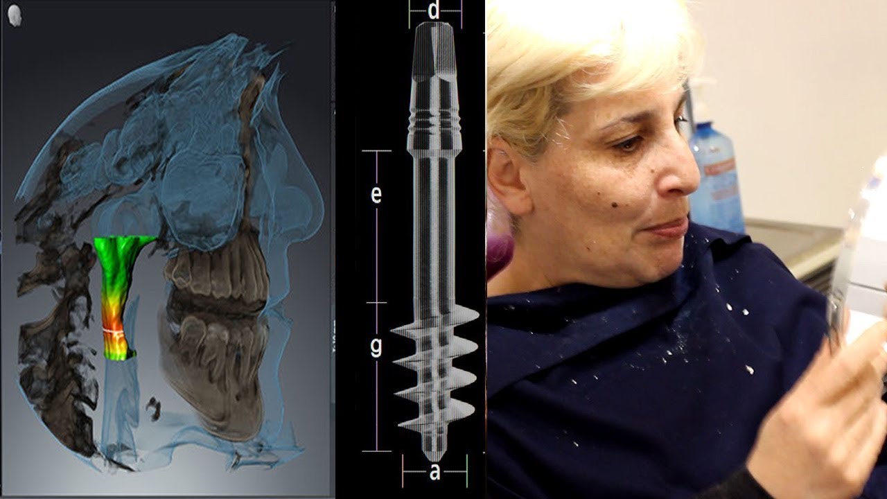 Implant dentaire basal #2 : Témoignage, douleurs, opération, avis