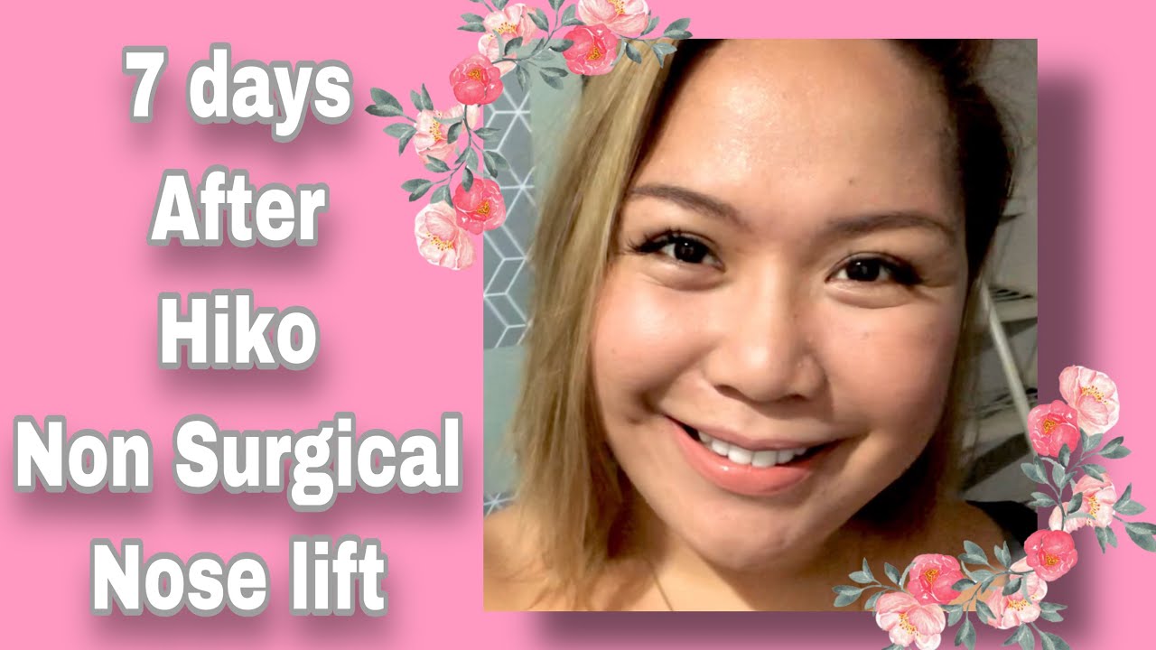 7 days after HIKO non surgical nose lift /FAQs | Ga Caballero