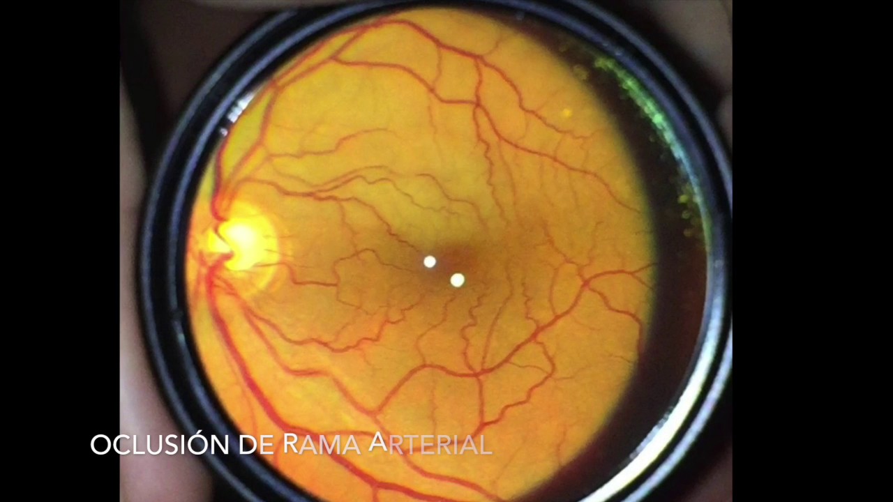 Cómo tomar fotos del fondo de ojo con tu celular