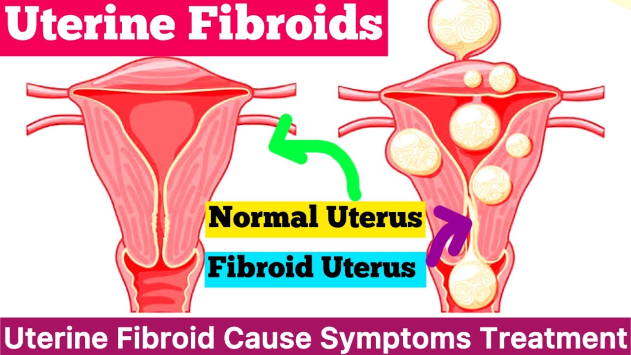 Uterine Fibroid Cause Symptoms Diagnosis Treatment || What is Uterine Fibroid || Uterine Fibroid