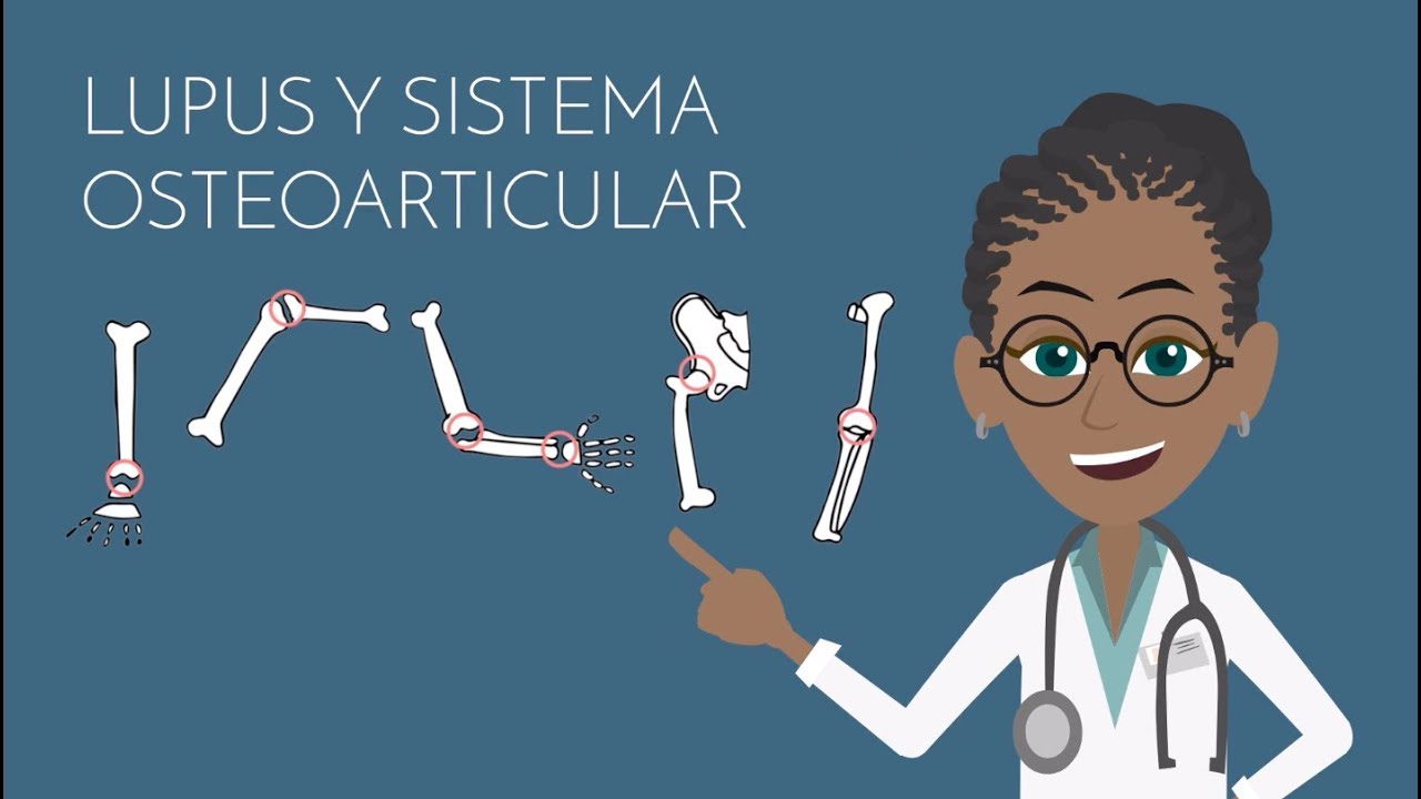 lupus y osteoarticular