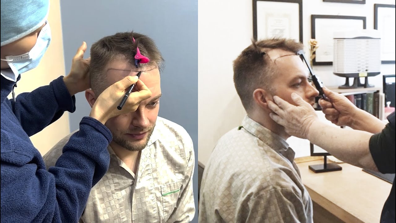 Full Hairline Design Process at Motion Clinic in Seoul Hair Transplant FUE 2200 grafts