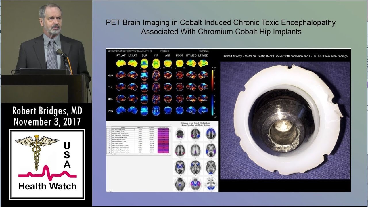 Brain Toxicity From Cobalt in Artificial Hip Implants As Seen on PET Scan