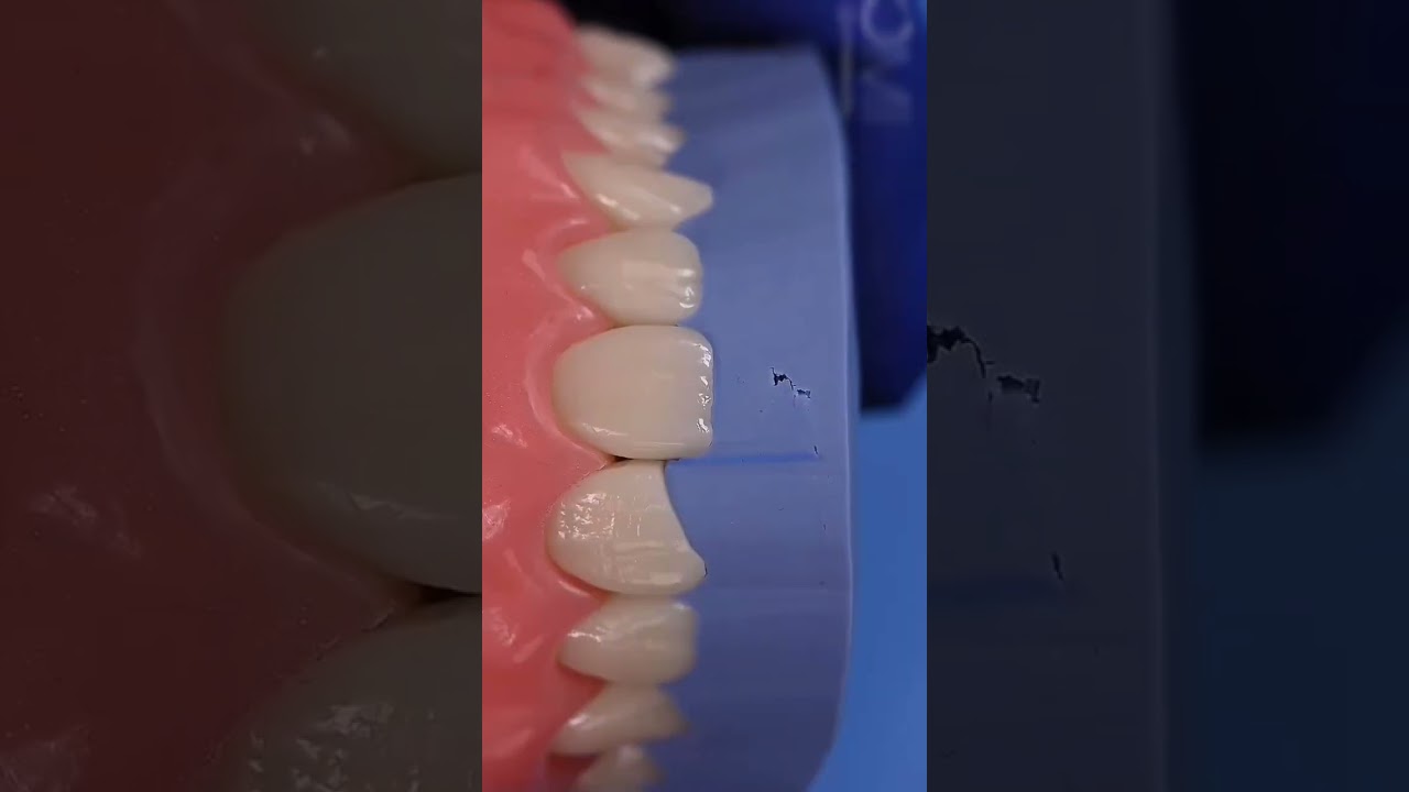 Dental motivation. Direct composite restoration teeth. Composite veneers #dental #dentistry #veneers