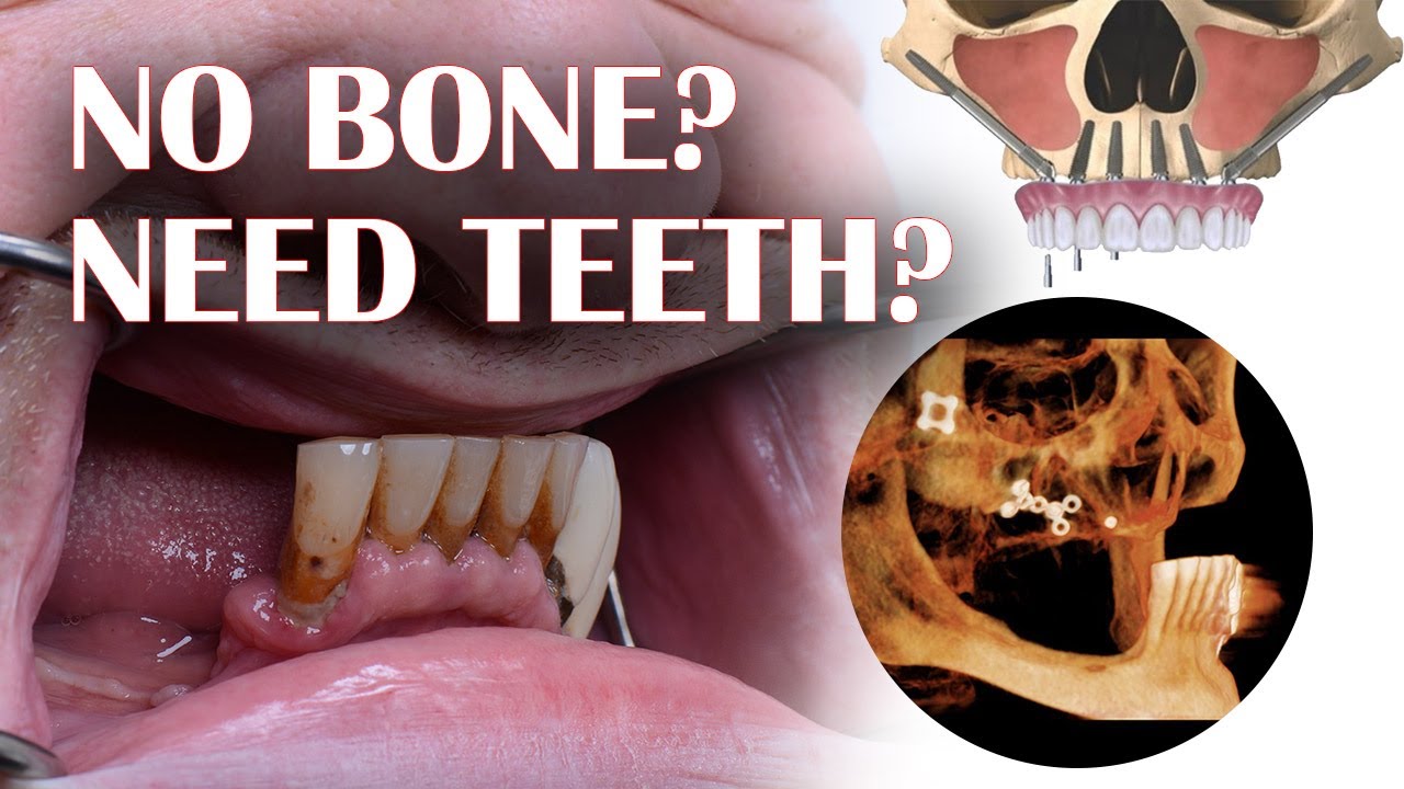 Lack of bone mass? Zygomatic Dental Implants Specialist is ready to help you!