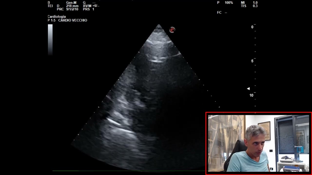 ANEURISMA DISSECATO AORTA ADDOMINALE