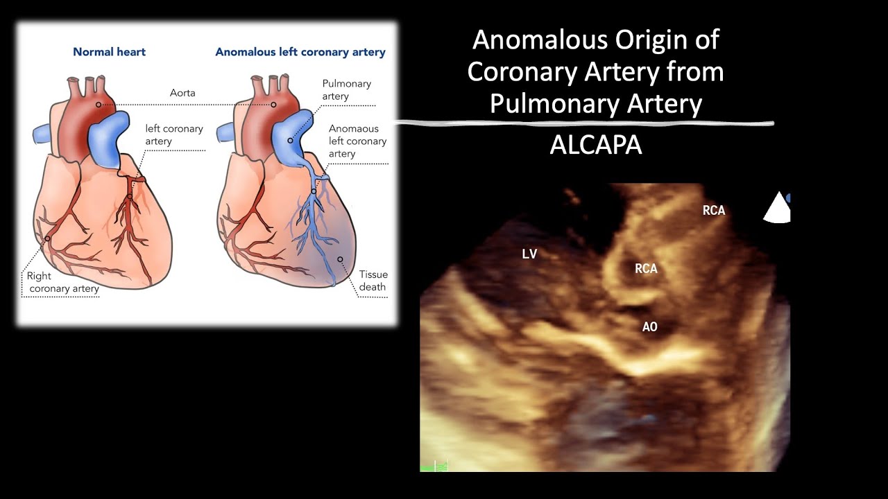 ALCAPA from Womb to Adulthood