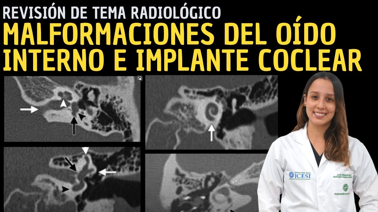 Revisión de Tema 89: Malformaciones del oído interno e implante coclear.
