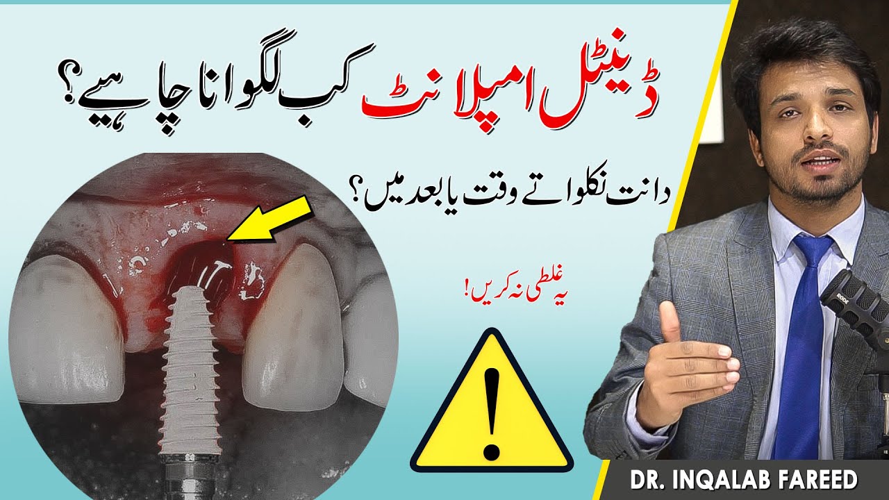 Best time for Dental Implant? | ​⁠@InqalabFareed