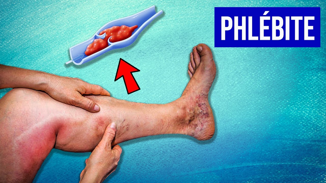 Phlébite (mollet) et embolie pulmonaire : Symptômes et Traitements