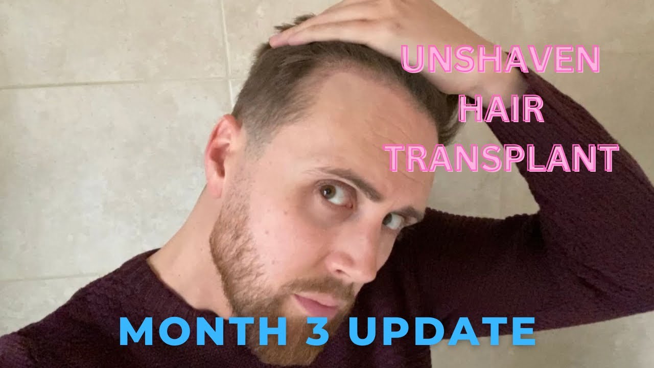 MONTH 3 UPDATE - Unshaven FUE Hair Transplant | 1200 Grafts by Dr Mwamba in Belgium | Second Surgery