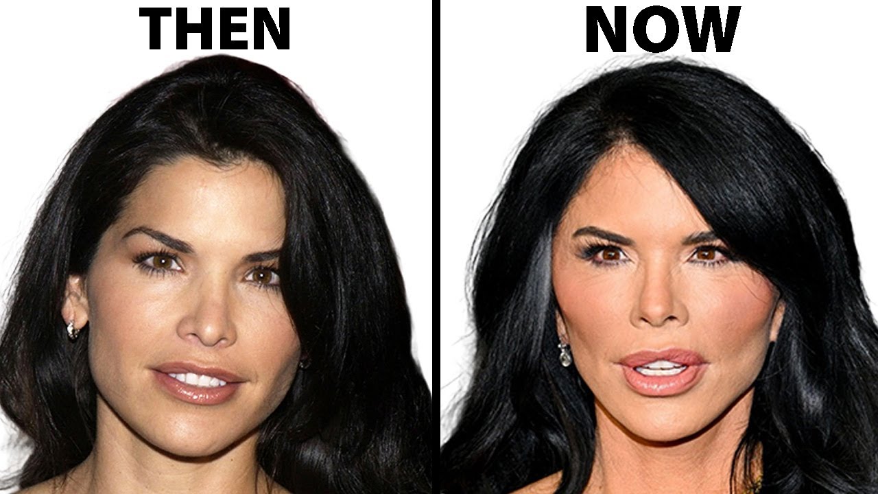 Lauren Sanchez's NEW FACE | Plastic Surgery Analysis