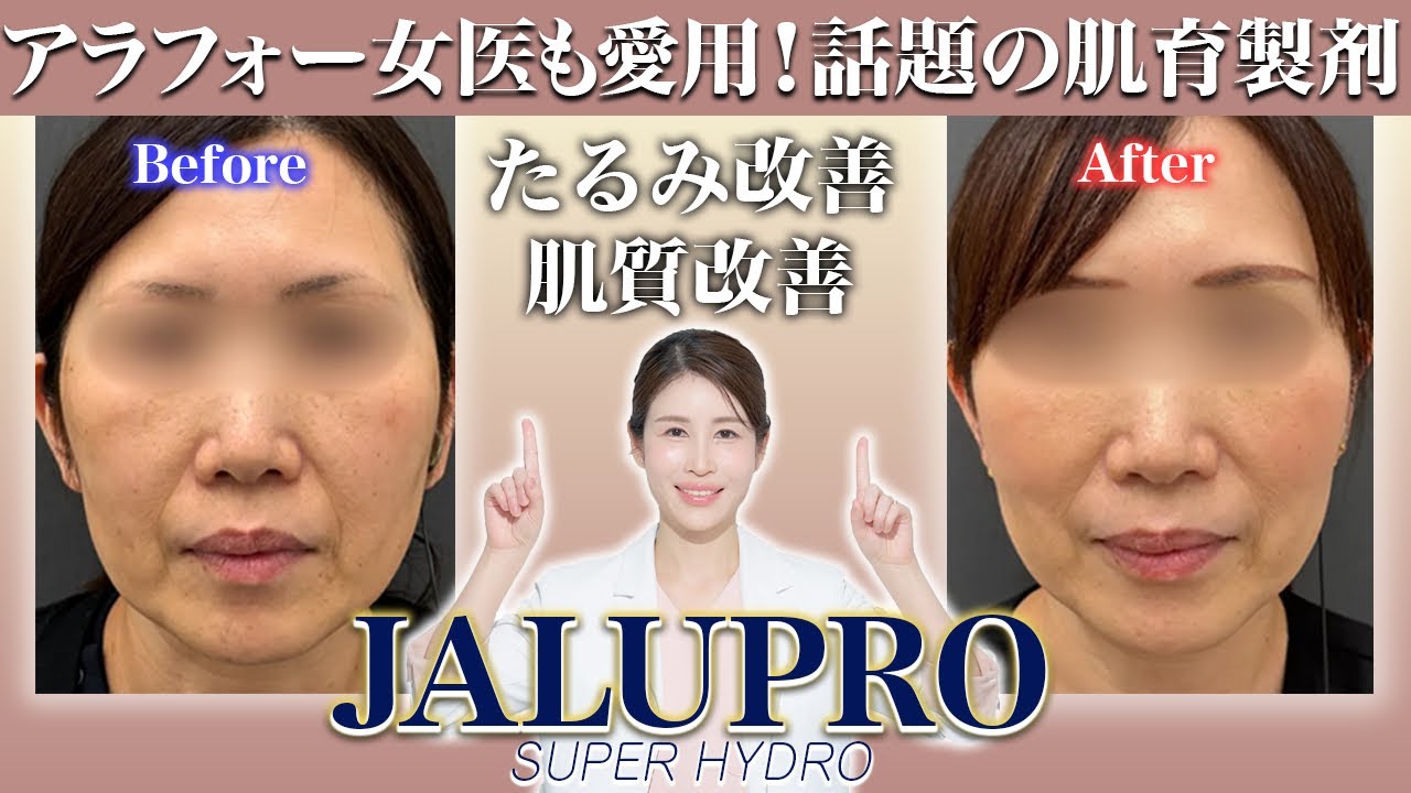 頬のコケやたるみ治療で話題沸騰中！肌育製剤ジャルプロスーパーハイドロについて医師が解説