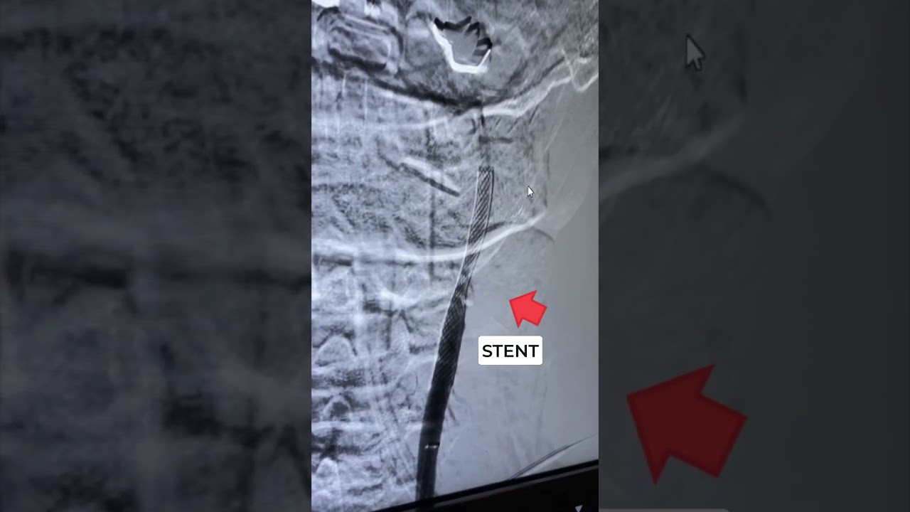 Şah Damarı tıkanıklığı, Stent,  Prof.Dr.Serdar Akg&uuml;n, Serdar Akg&uuml;n Tıp Videoları