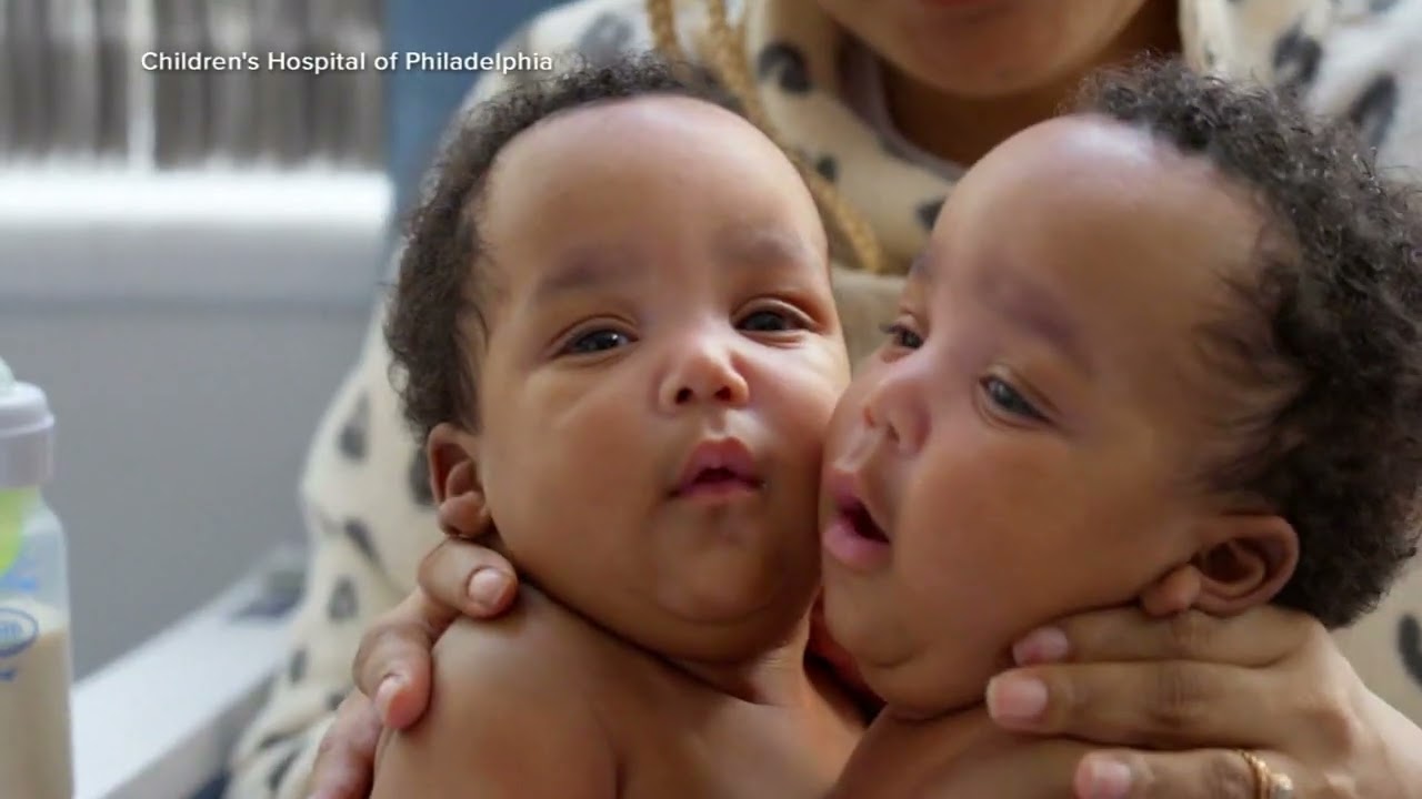 Twins celebrate 1st birthday weeks after separation surgery at Children's Hospital of Philadelphia