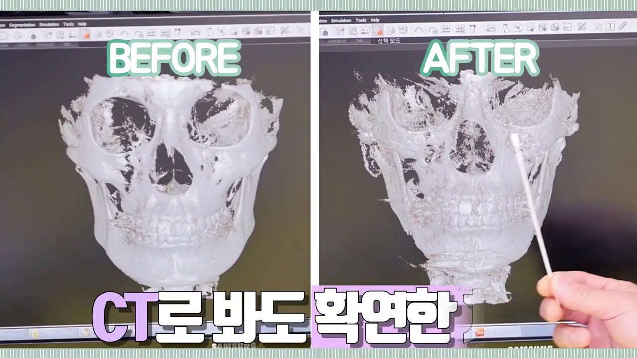 [ENG Sub] The REAL BEFORE AND AFTER FACIAL CONTOURING SURGERY