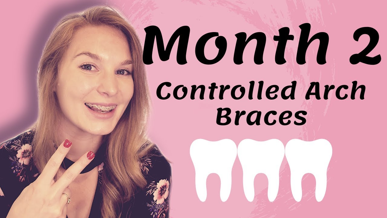 Month 2 Braces Update | Controlled Arch Braces