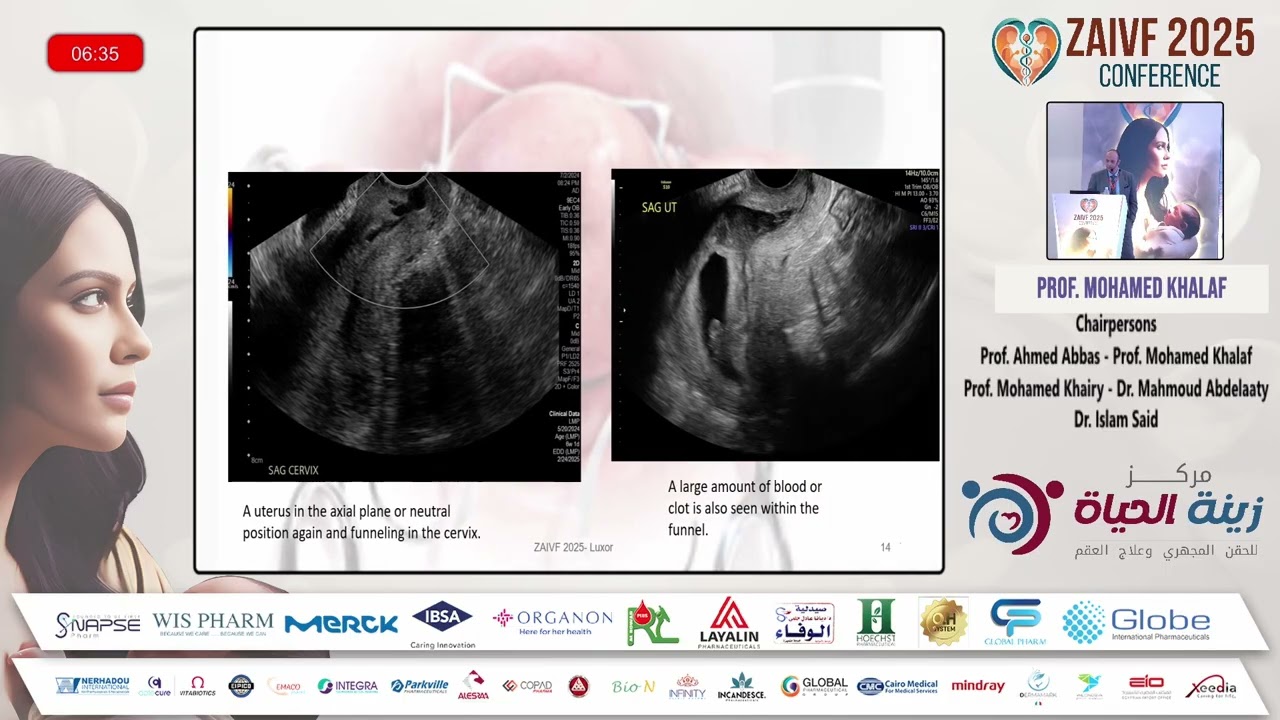 دكتور محمد خلف Cervical insufficiency and cerclage من مؤتمر ZAIVF