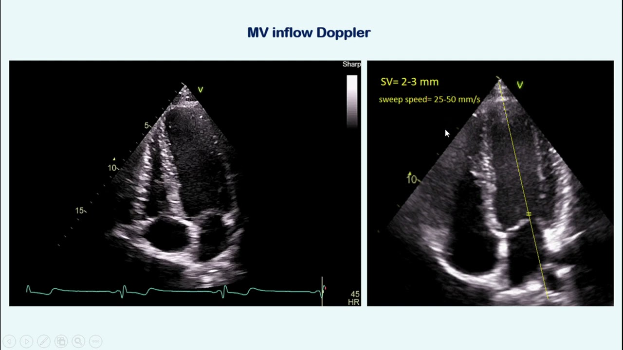 Diastolic Dysfunction part I