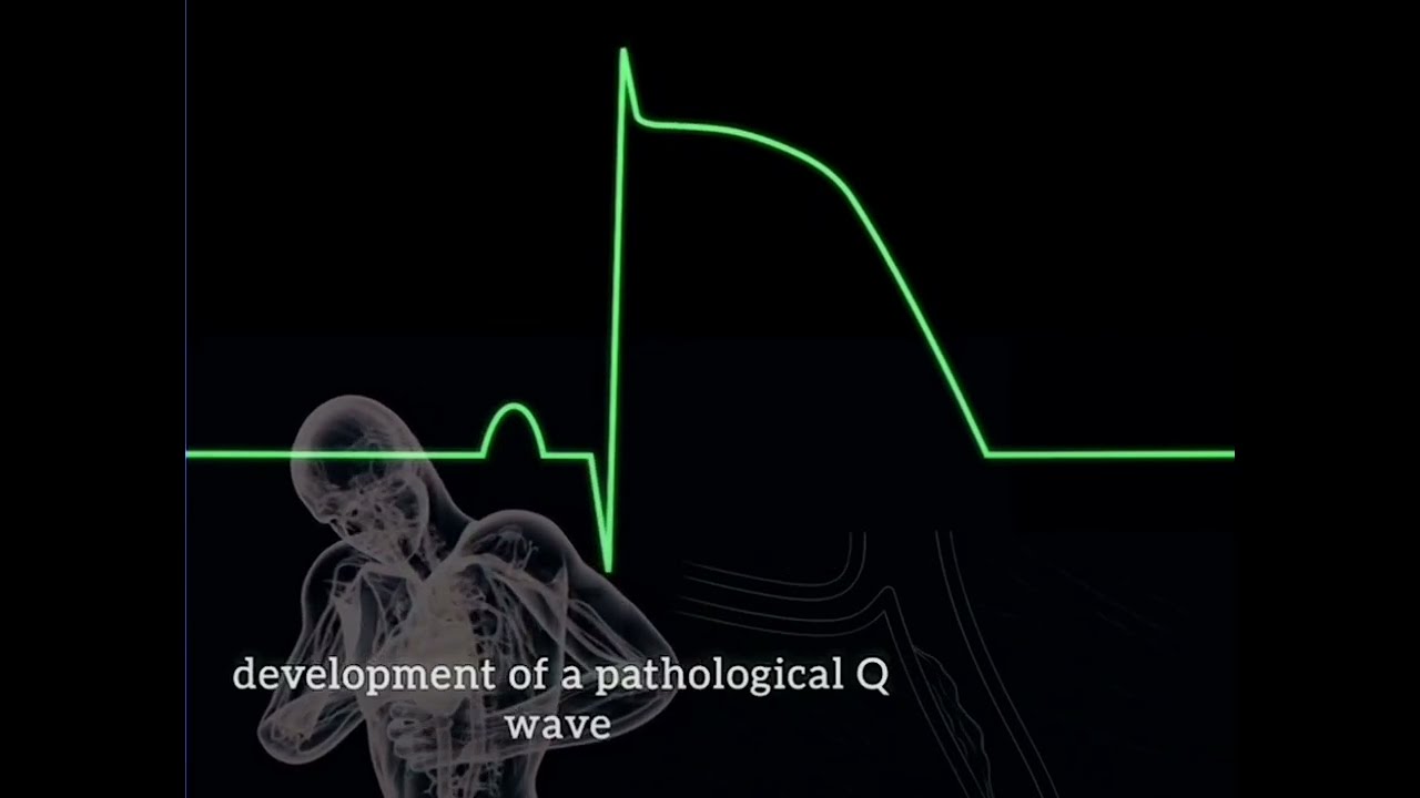 ECG changes during Myocardial infarction......