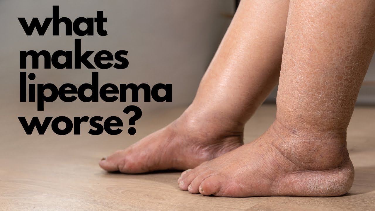 What makes lipedema worse? Role of inflammation