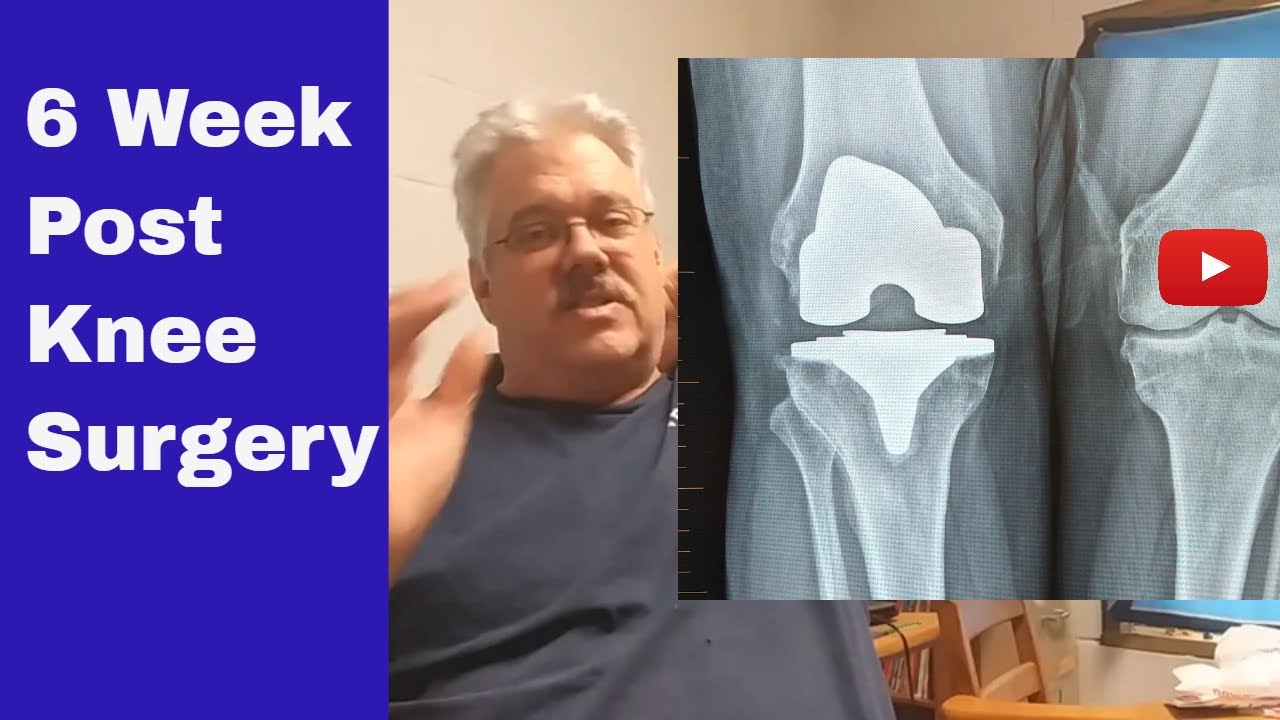 6 week update after my total knee replacement surgery and doing good