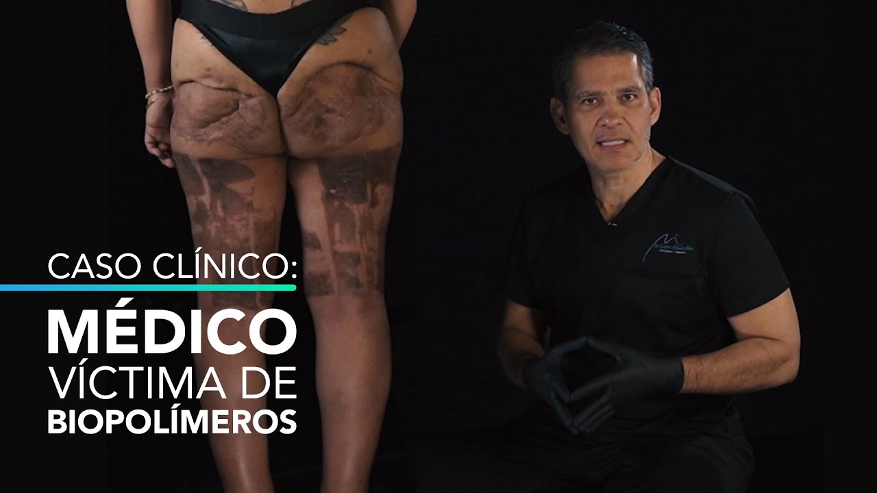 Médico es víctima de inyección de biopolímeros