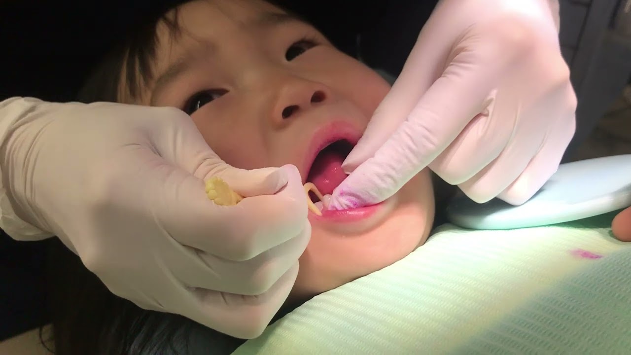 일본일상 세자매 브이로그│일본 어린이 치과에서 충치 예방 치료하는 37개월 해영