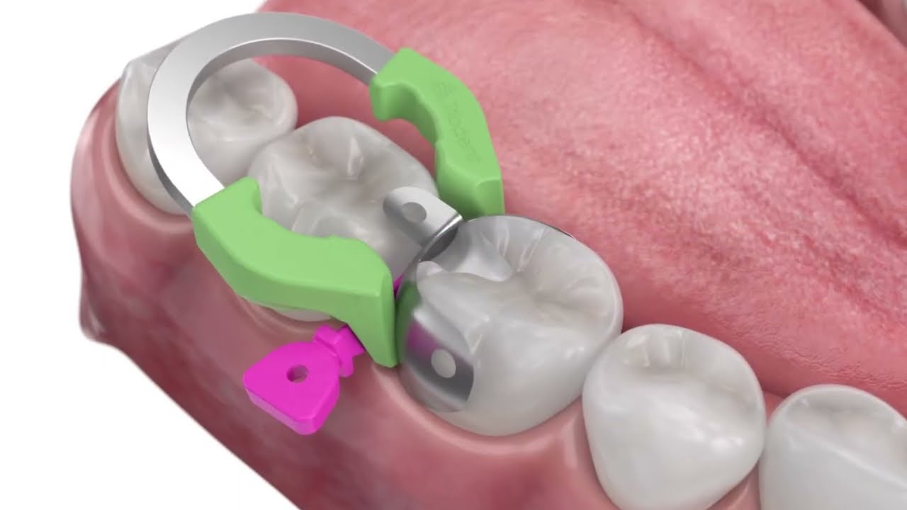 Triodent V3 Sectional Matrix System: Award-Winning Solution for Reliable Class II Restorations