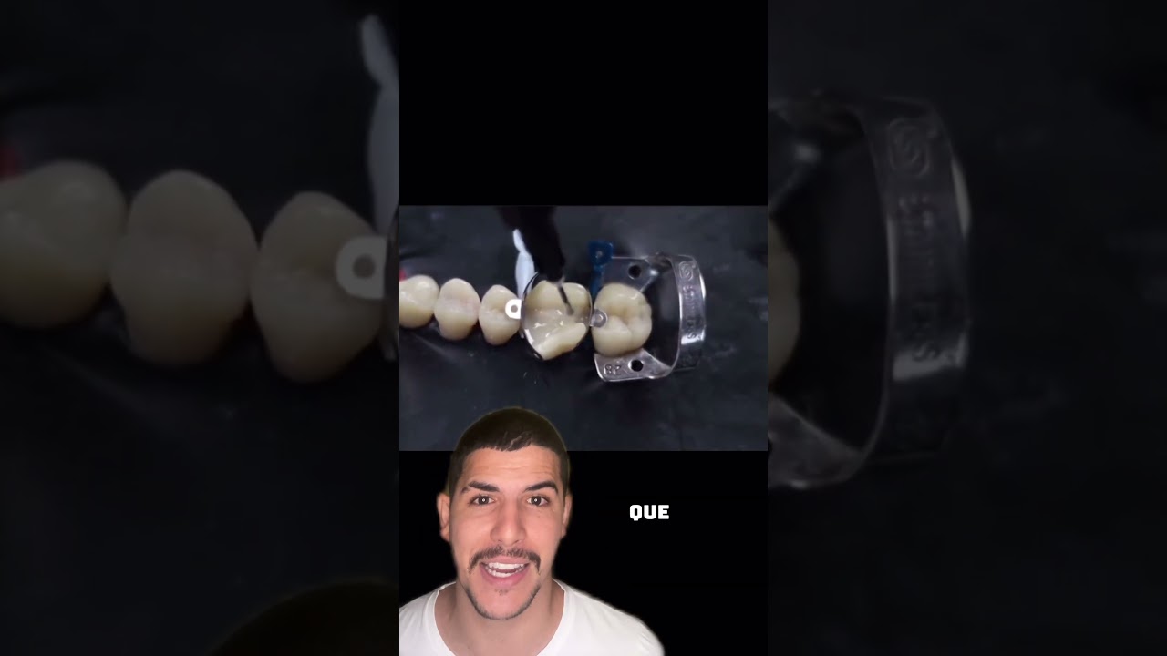 J&aacute; ouviu falar da Overlay? #curiosidades #dentes #dentist #dentista #dicas #odonto