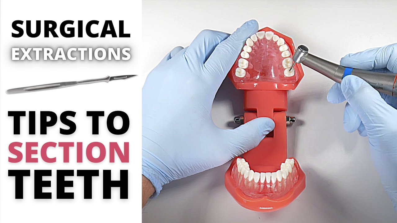 SURGICAL EXTRACTION SECTIONING TIPS | OnlineExodontia.com