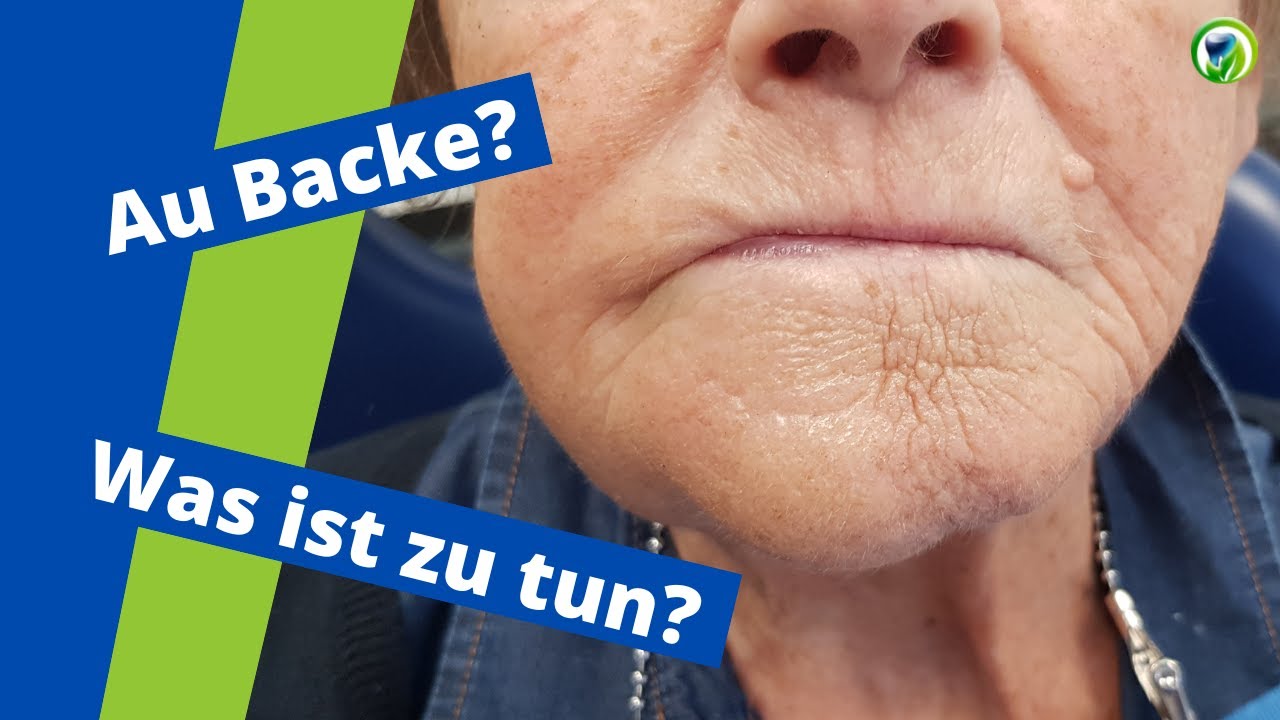 Dicke Backe, Schwellung, starke Schmerzen - Was ist zu tun? Abszess -  Patientenfall , Therapie