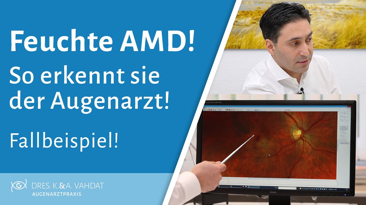 Wie erkennt der Augenarzt eine feuchte Makuladegeneration?