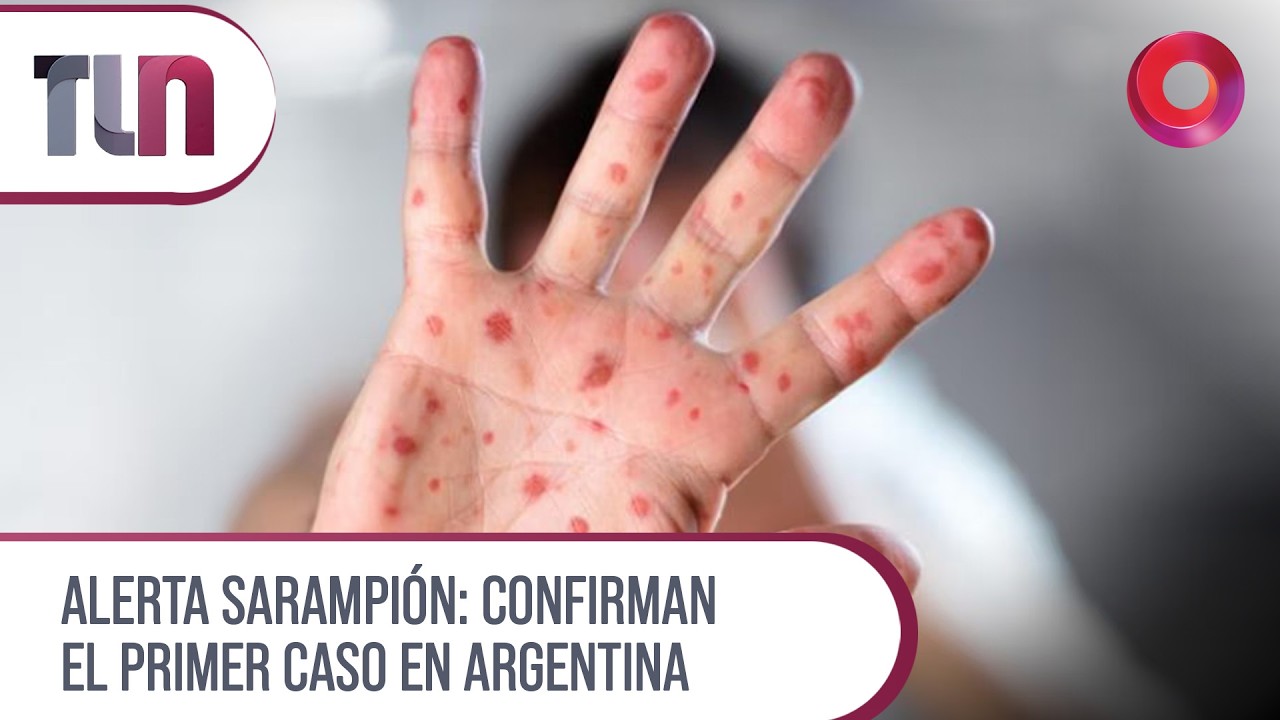 #Telenueve | Alerta sarampi&oacute;n: Confirman el primer caso en Argentina