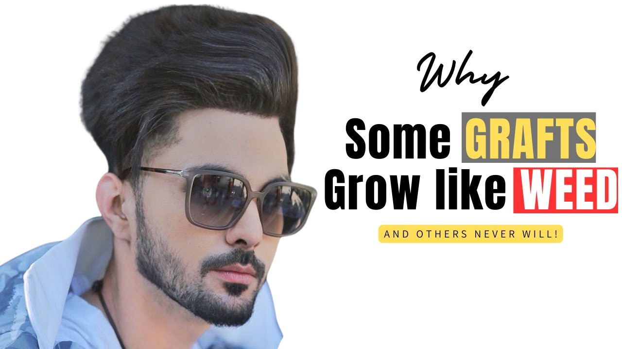 Hair Transplant in India | How to get the Best Results of hair transplant?