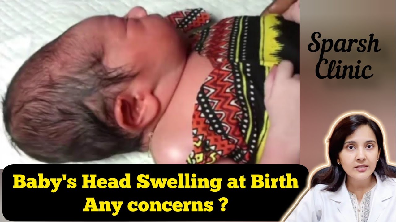 Baby's head swelling at birth. Any concerns ?