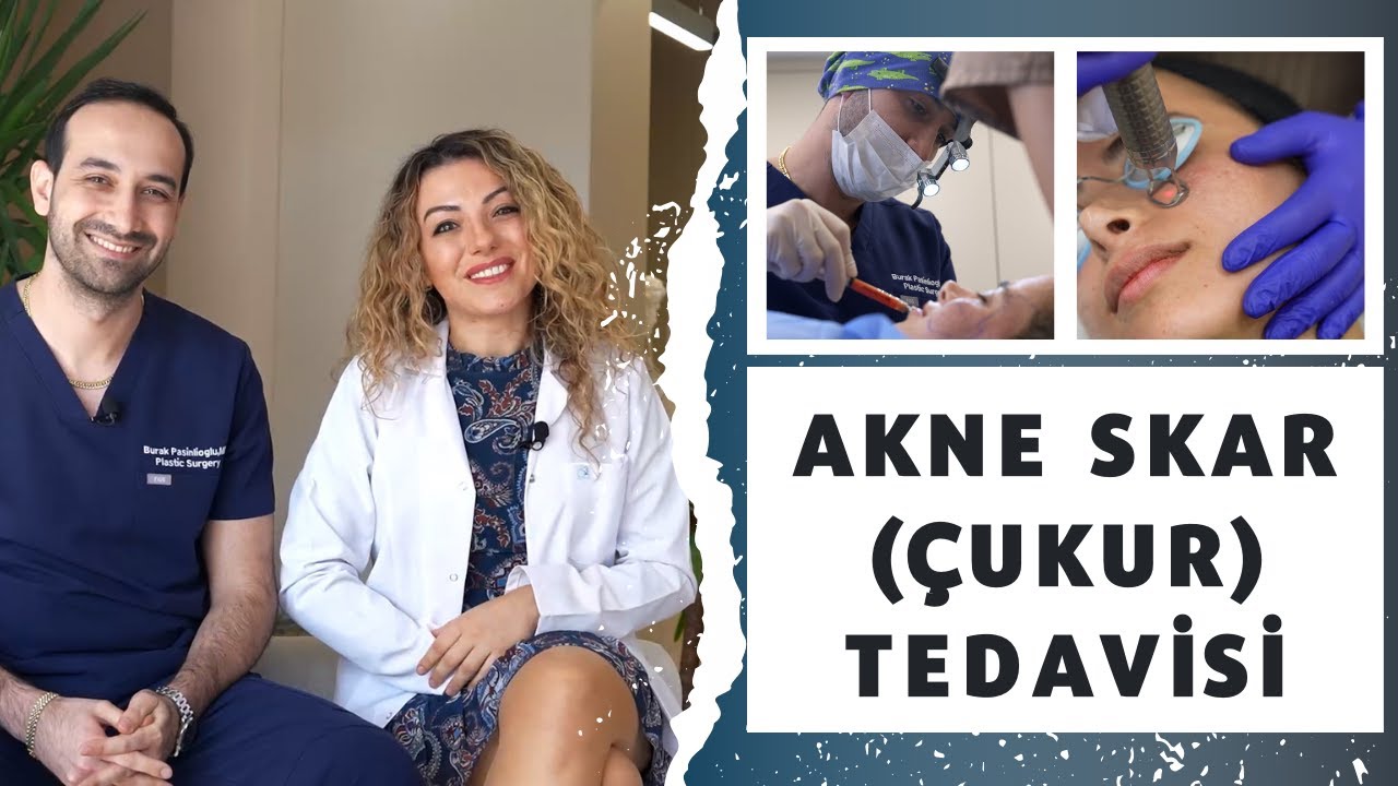 Akne Skarları (Çukurları) Tedavisinde Ne Yapıyoruz?  @drburakpasinlioglu
