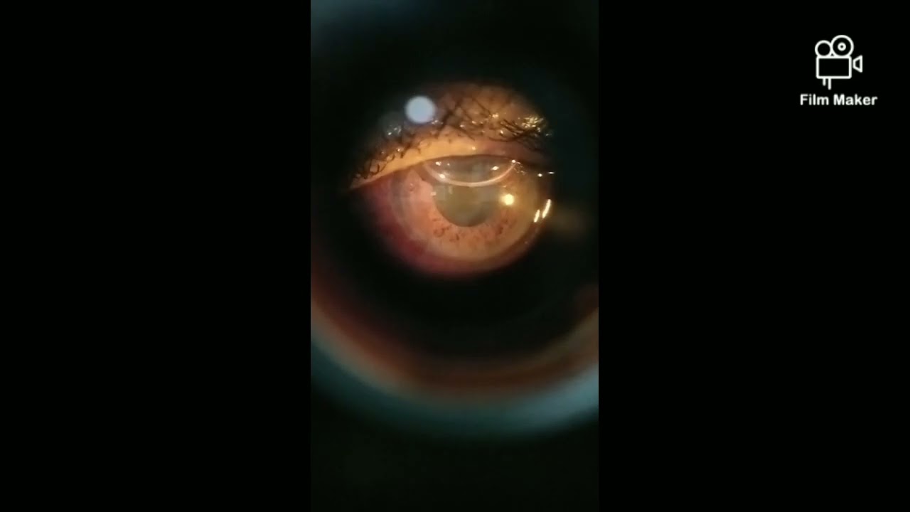 Air bubble in Anterior chamber