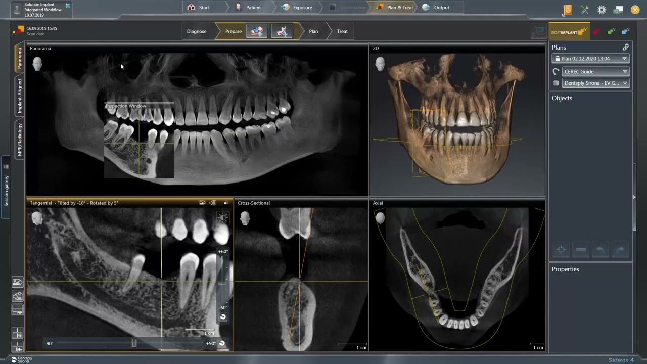 Sidexis SW 4 - Digital Chairside Implant Workflow (2/5)