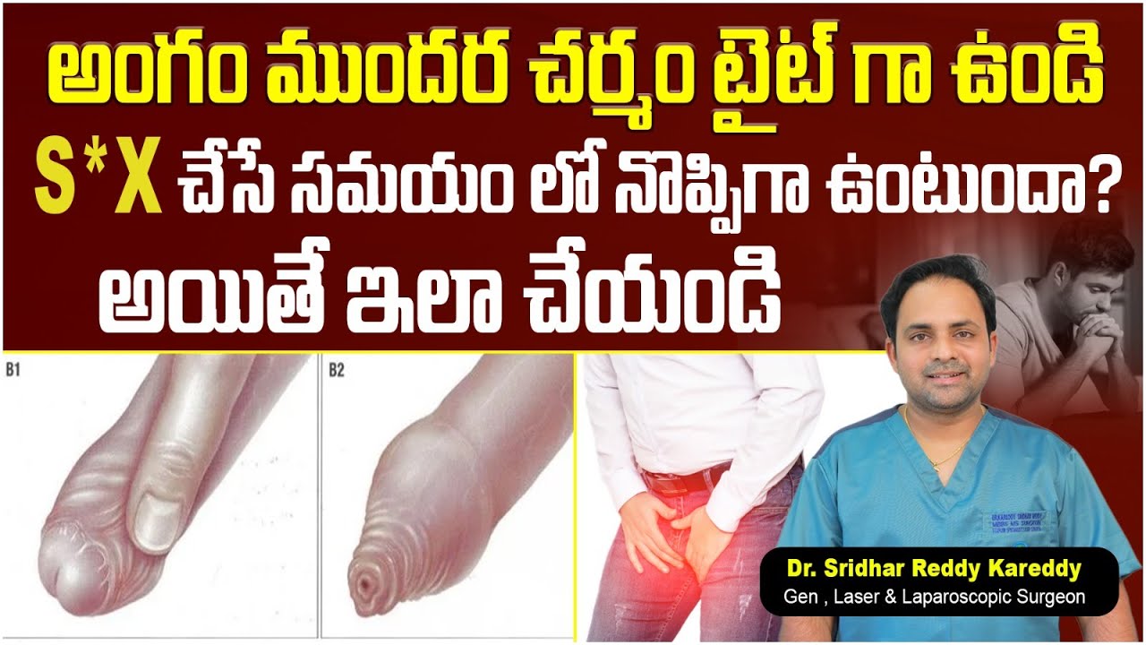 How to Loose Tight Foreskin || Symptoms of Balanitis and Balanoposthitis || Treatment Range Hospital