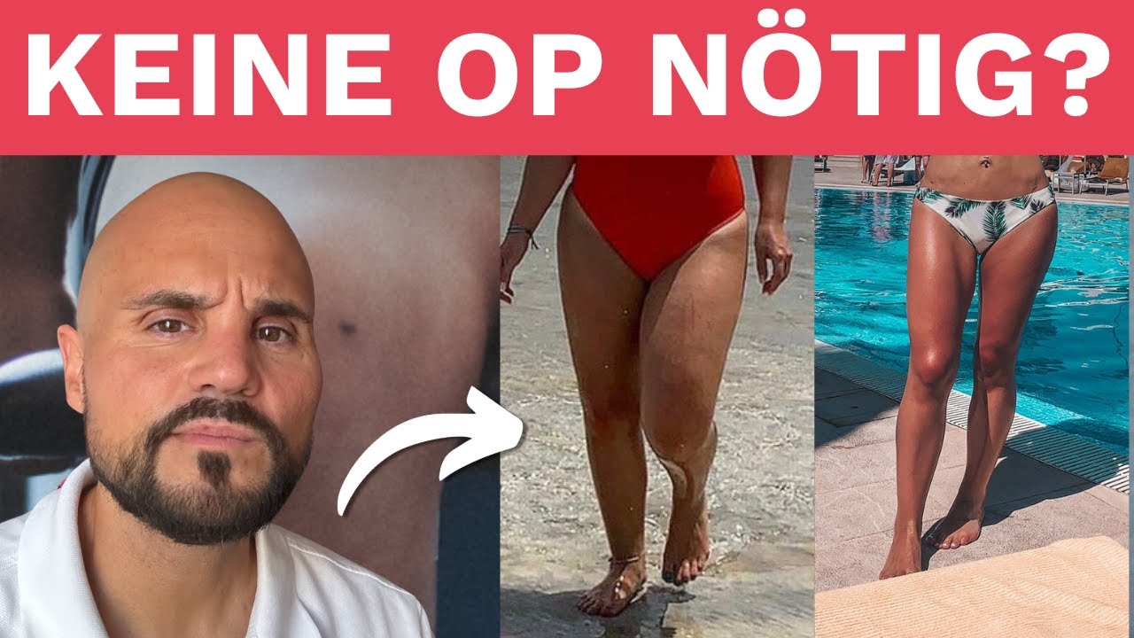 Die richtige Ernährung bei Lipödem – warum sie wichtiger ist als jede OP!