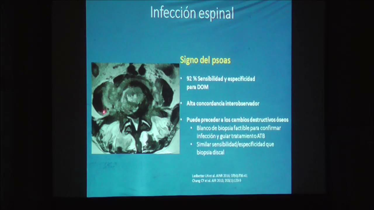 Infecciones espinales, conceptos fundamentales. Sergio Moguillansky