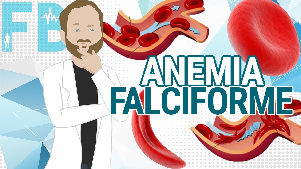 Anemia falciforme