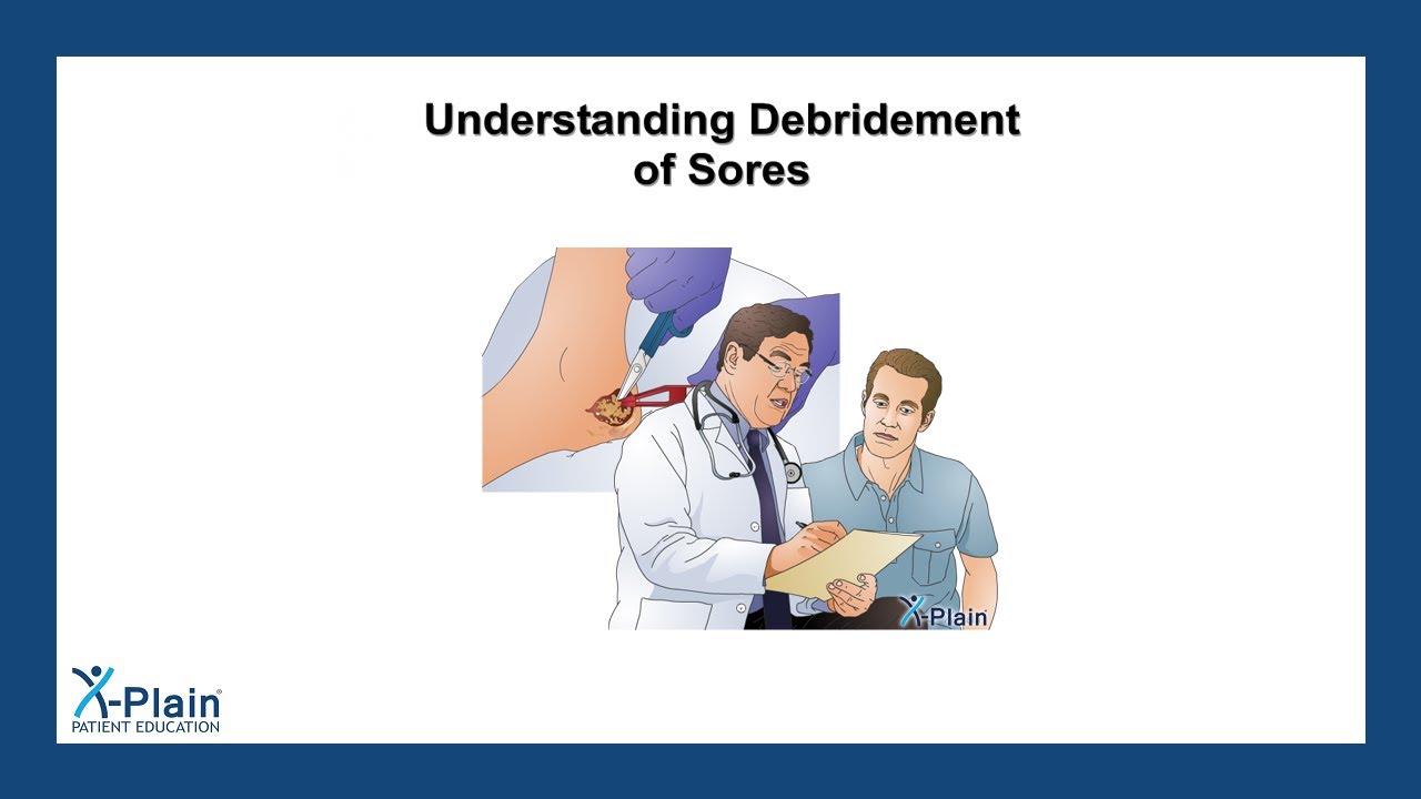 Understanding Debridement of Sores