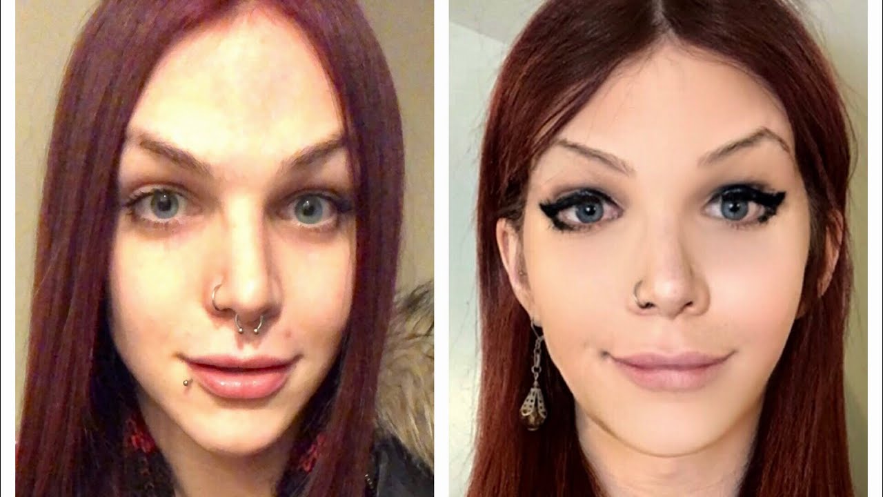 Facial Feminization Results | Before/After (1 Year Later)