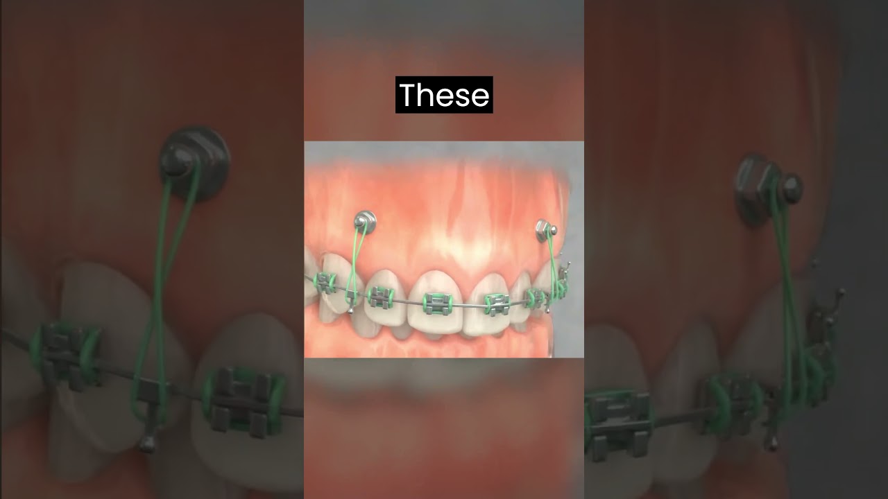 TADs 3 : The next level Orthodontic treatment technique