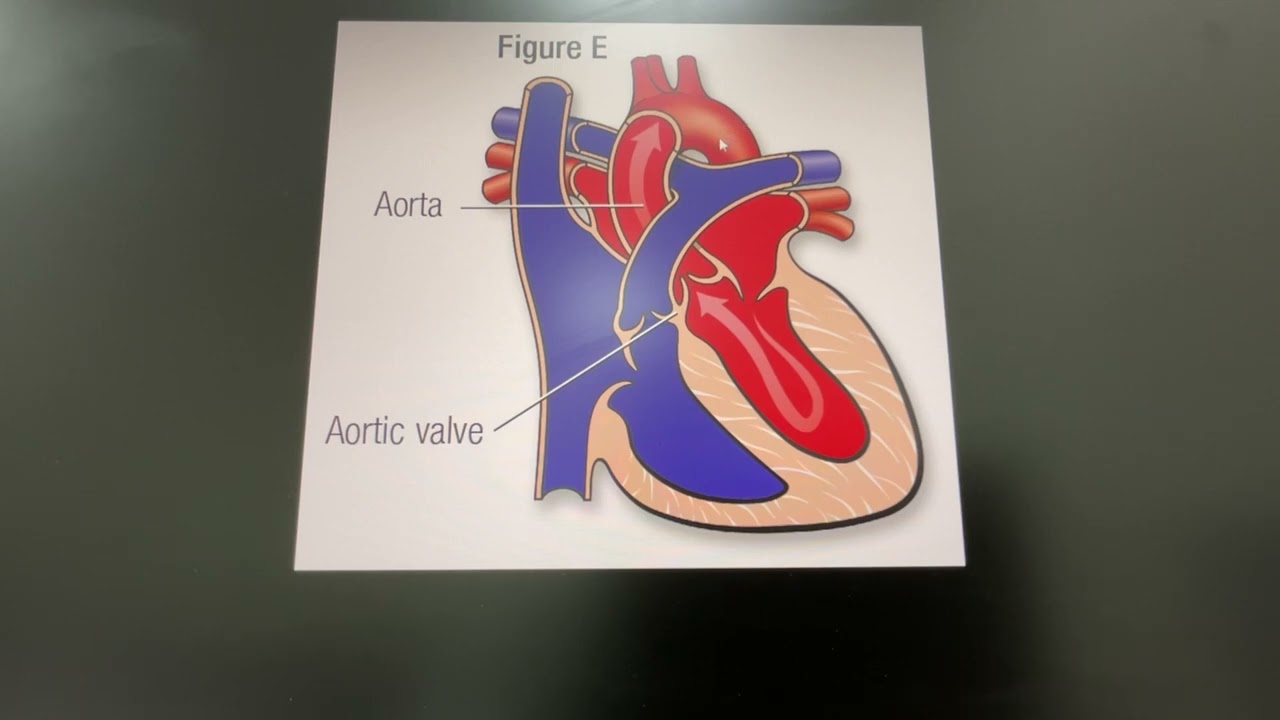 Heart Failure , what is Ductal Dependent Lesions