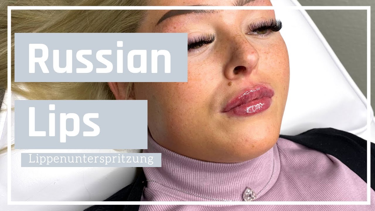 lippenunterspritzung mit hyaluronsäure | russian  lips | Heilungsverlauf | Schwellung | Massage|