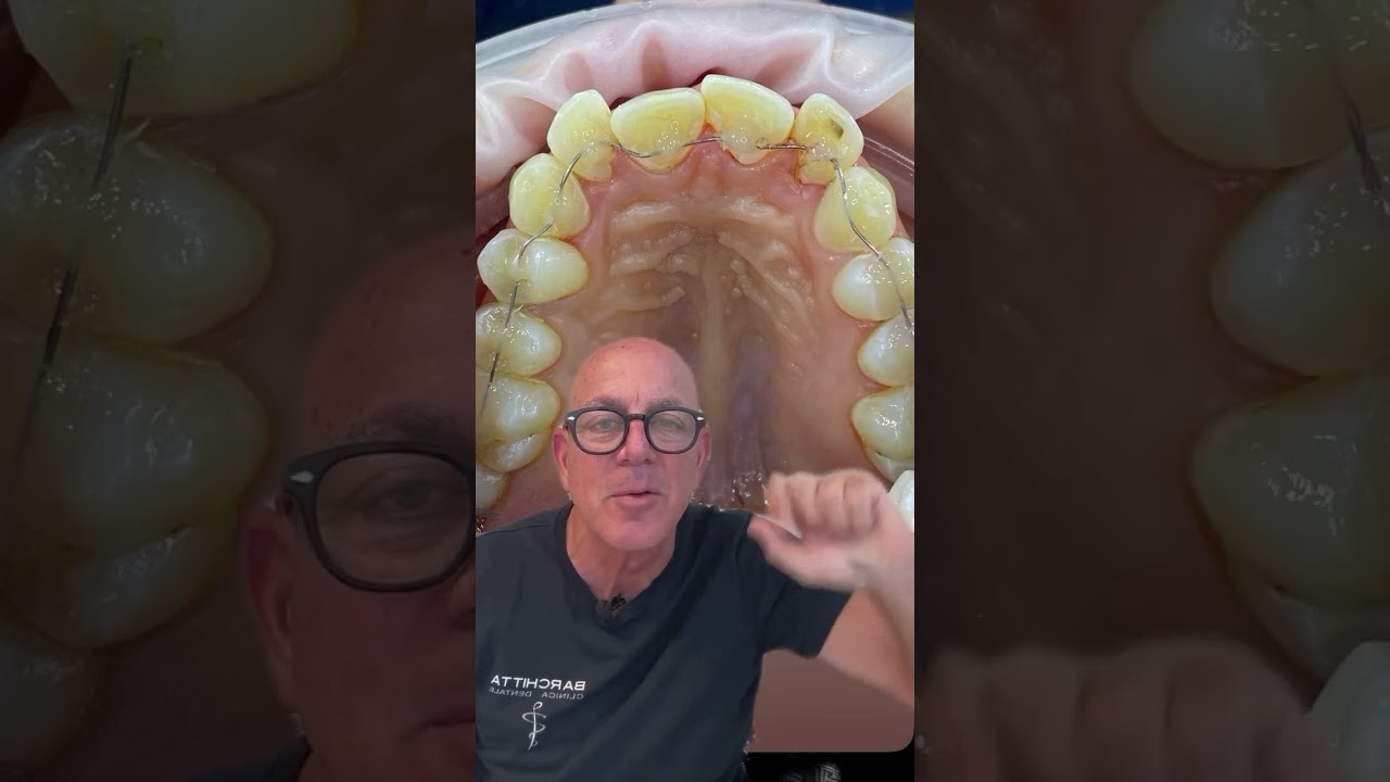 FILO INVISIBILE e DENTI ALLINEATI (senza mascherine e senza ferretti)