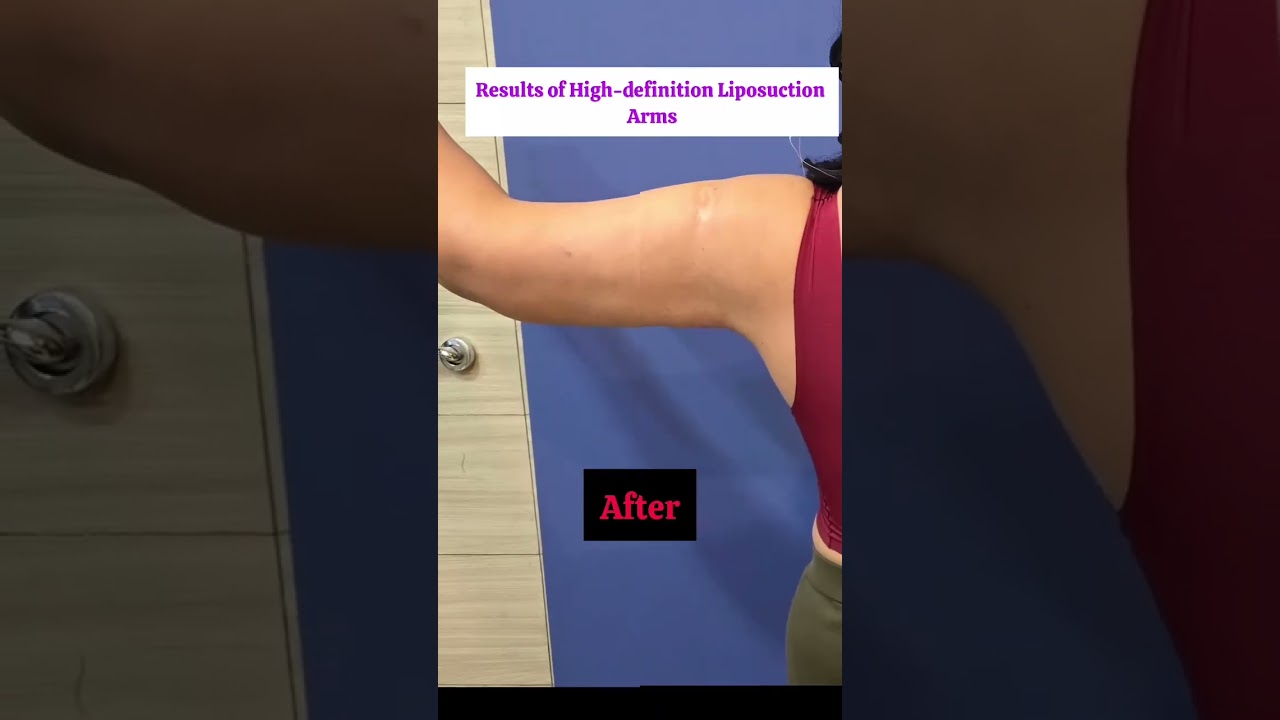 Get Sculpted Arms with High-Definition Liposuction | Permanent & Natural Results